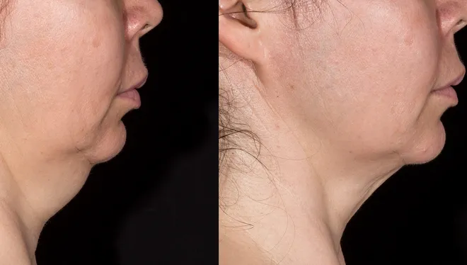 Turkey Neck Causes & Treatments Restore Youthful, Firm Neck Today
